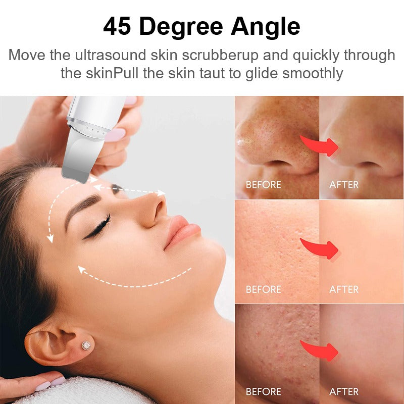Ultrasonic Skin Spatula Facial Skin Scrubber – Deep Cleansing - Free Shipping